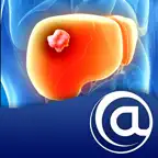 Hepatocellular Carcinoma iOS Icon