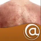 Atopic Dermatitis iOS Icon