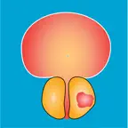 Nyushko prostate nomograms iOS Icon