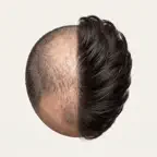 Replant: Hair Transplant Truth iOS Icon